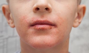 EC approves Dupixent for children aged six to 11 to treat atopic dermatitis