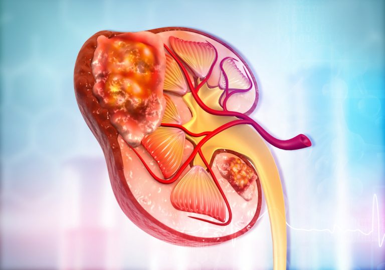 Kidney Cancer And Metastasis at Mary Duffey blog