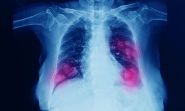 European Commission approves Lumykras® for lung cancer treatment