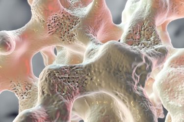 FDA Approves Prolia For Glucocorticoid-induced Osteoporosis