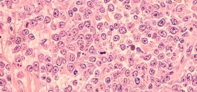 diffuse large B-cell lymphoma (DLBCL) ViPOR