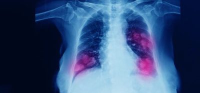 Sanofi stops development of lung cancer drug, tusamitamab ravtansine
