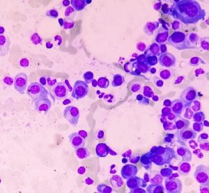 SARCLISA multiple myeloma