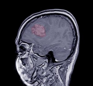 meningioma radiopharmaceutical 177Lu-Dotatate