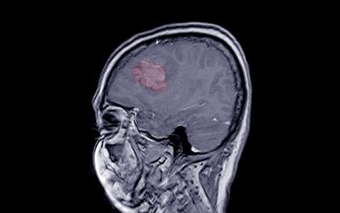 meningioma radiopharmaceutical 177Lu-Dotatate