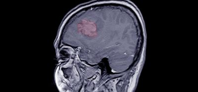 meningioma radiopharmaceutical 177Lu-Dotatate