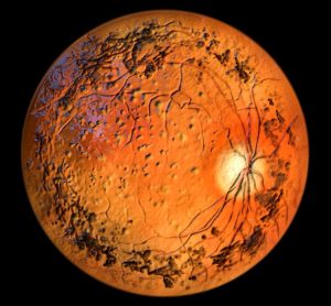 modifier gene therapy retinitis pigmentosa