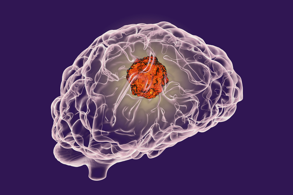 brain-tumour